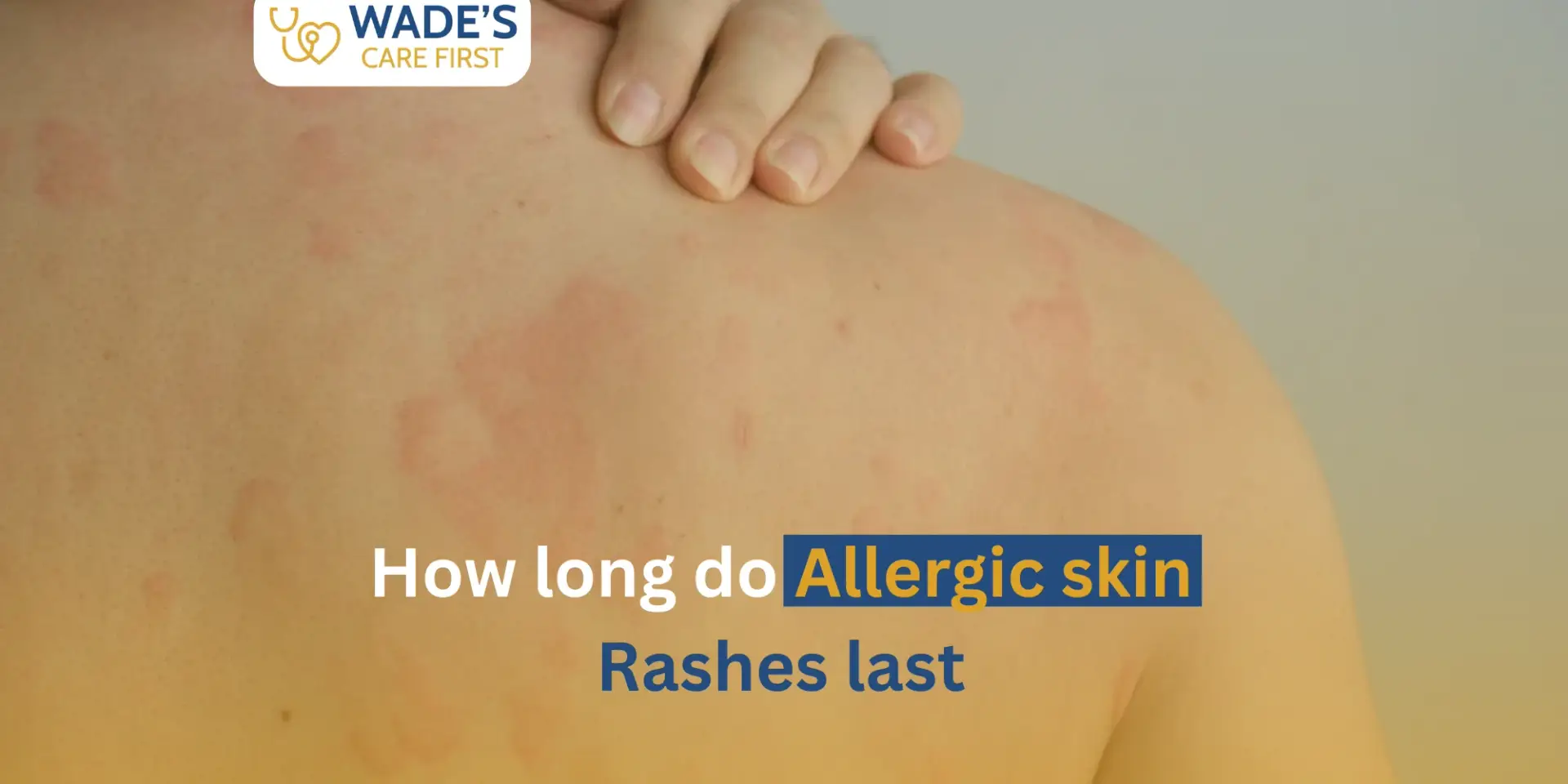How Long Do Allergic Skin Rashes Last?