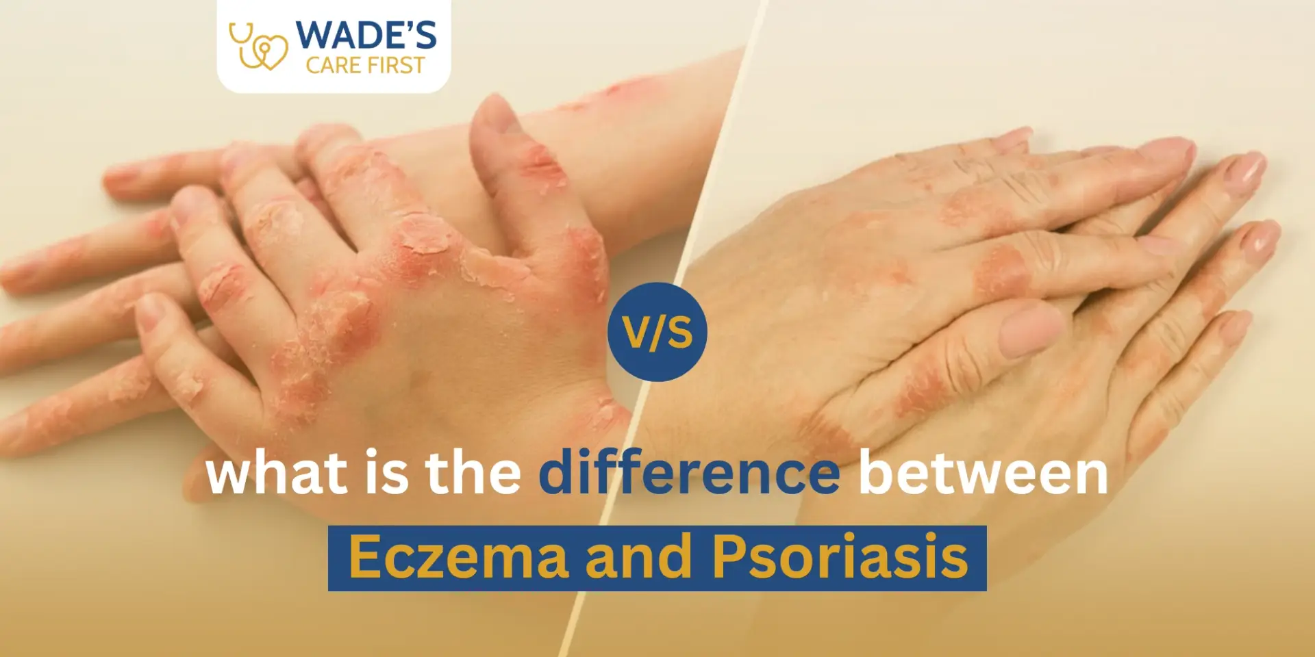 What Is the Difference Between Eczema and Psoriasis?